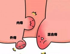 内痔、外痔、混合痔有什么不同，怎么