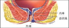 痔疮不痛需要治疗吗？提醒：不痛更要