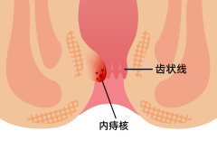 为什么有的痔疮感觉不到疼呢？