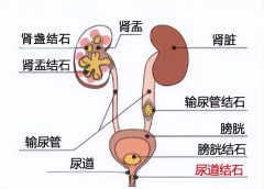 为什么夏季泌尿系结石发病率特别高？